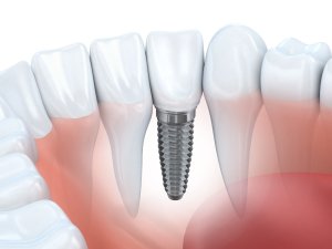 dental implants