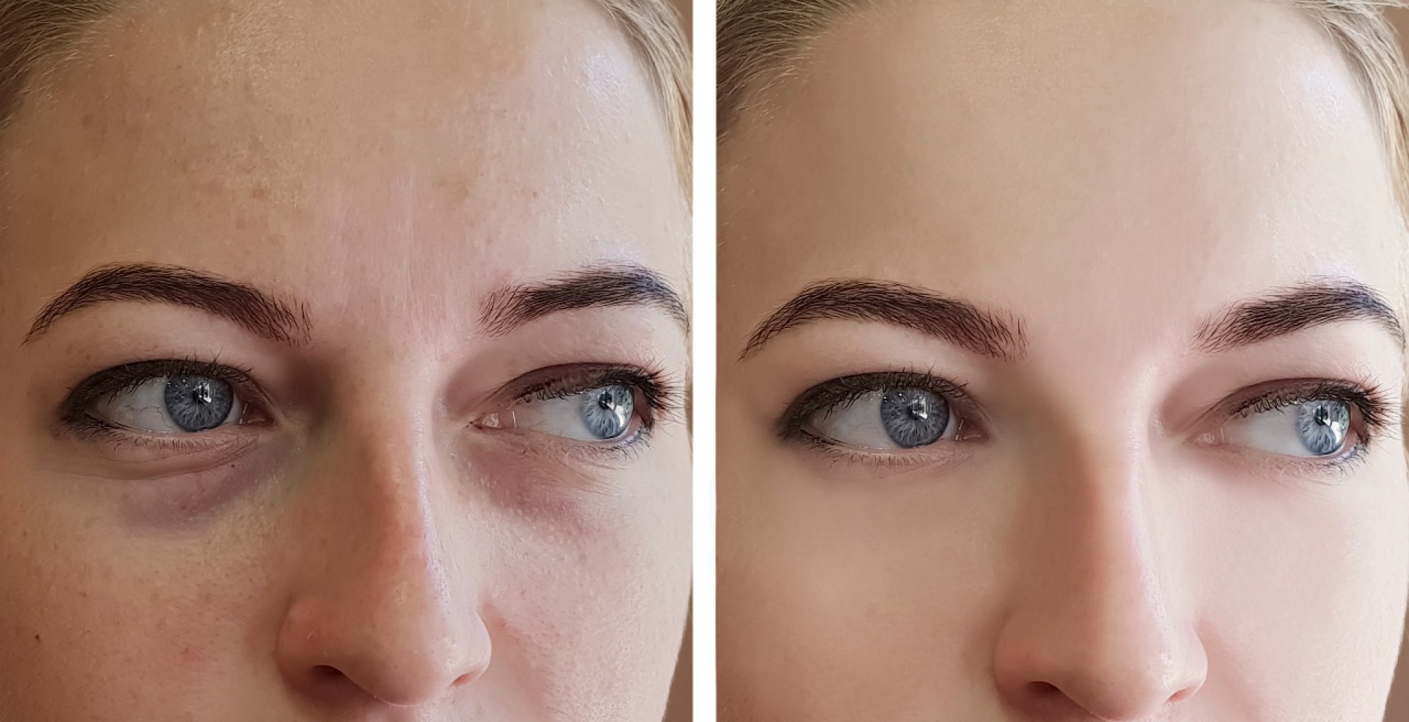 Natural remedies for puffy eyes 4 methods (and 3 of our favorite products)