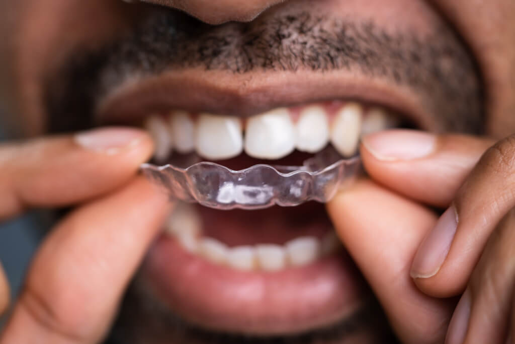 ceramic braces or invisalign