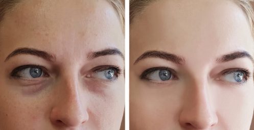 4 natural remedies for puffy eyes (and 3 products that can help)